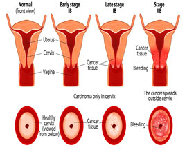 Cervical Cancer Screening (Package)